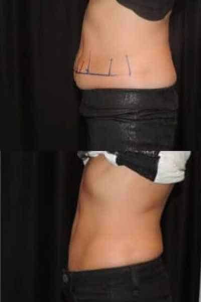 HIEMT Muscle Toning Bloxwich